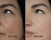 Wrinkles & Fine lines