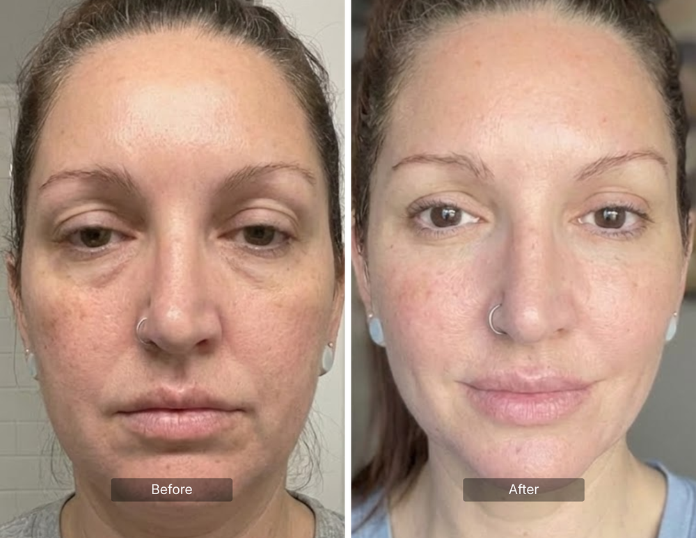 Puffiness & Sagging Skin