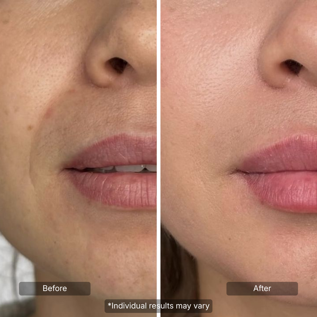 Line Smoother Targeted Fine Line Filler