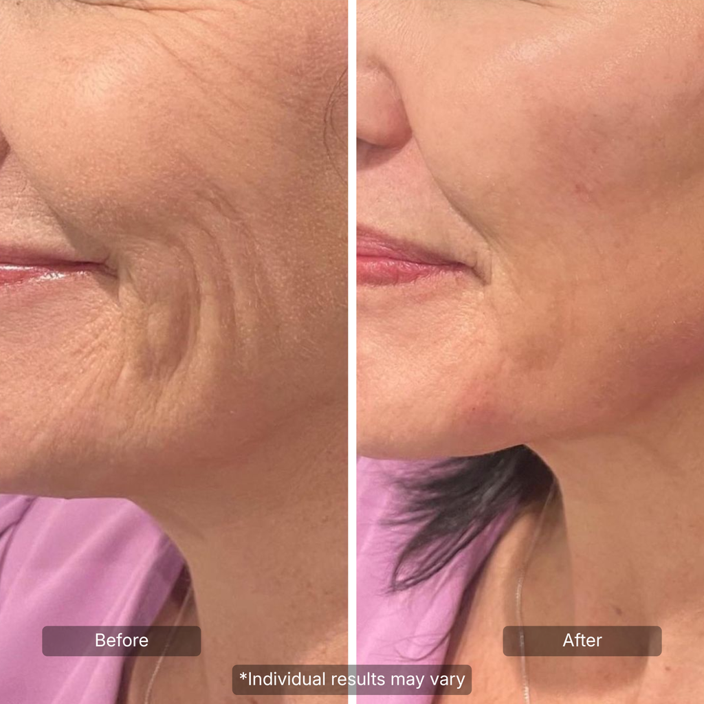 Line Smoother Targeted Fine Line Filler