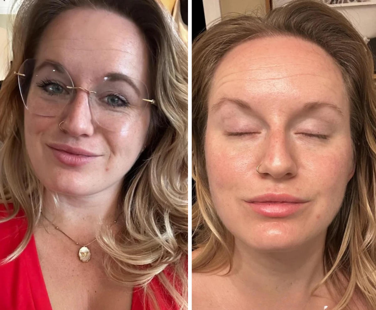 Melissa before and after