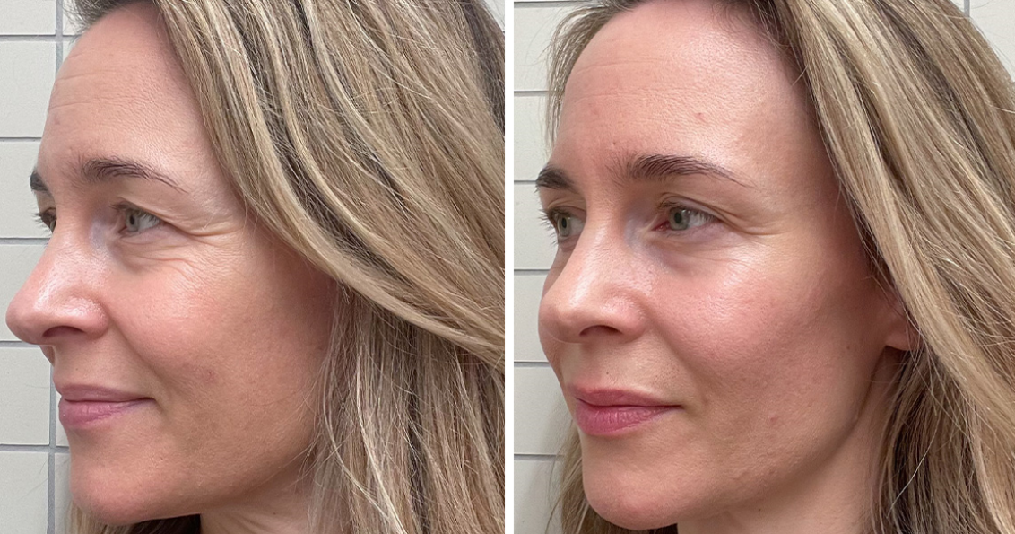 Alice before and after